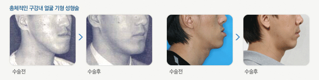 총체적인 구강내 얼굴 기형 성형술