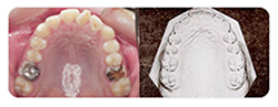 정상적인 치아상태 정상교합 설명사진4