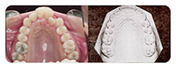 정상적인 치아상태 정상교합 설명사진5