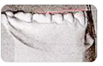 정상적인 치아상태 정상교합 설명사진6